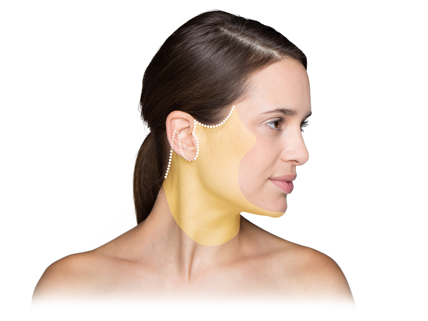 Facelift: 
            Die Haut im Wangen- und Halsbereich wird präpariert.
