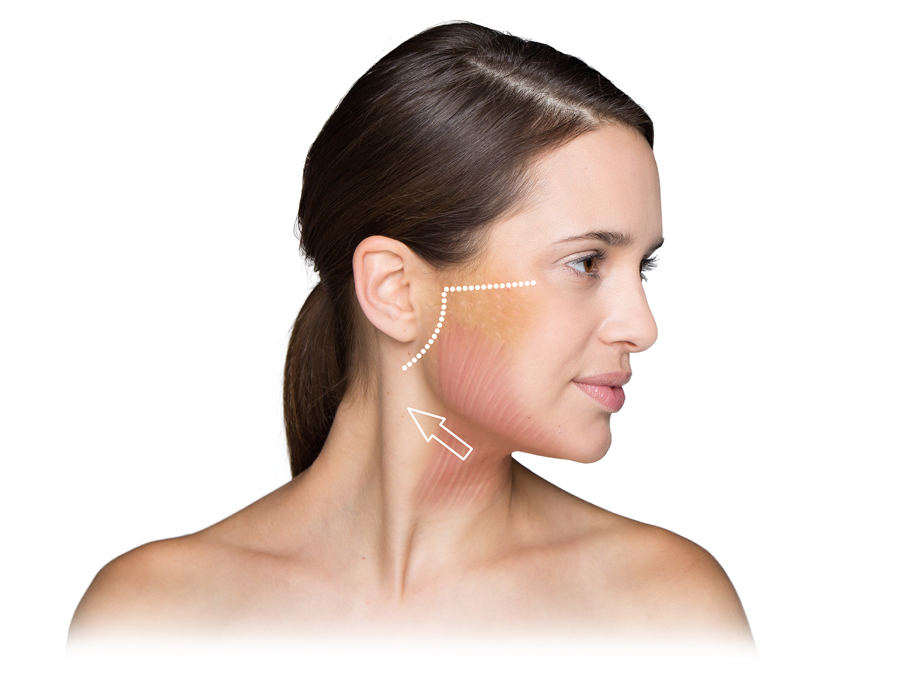 Facelift: 
            Die Muskulatur im Halsbereich wird parallel zum Unterkiefer gestrafft.