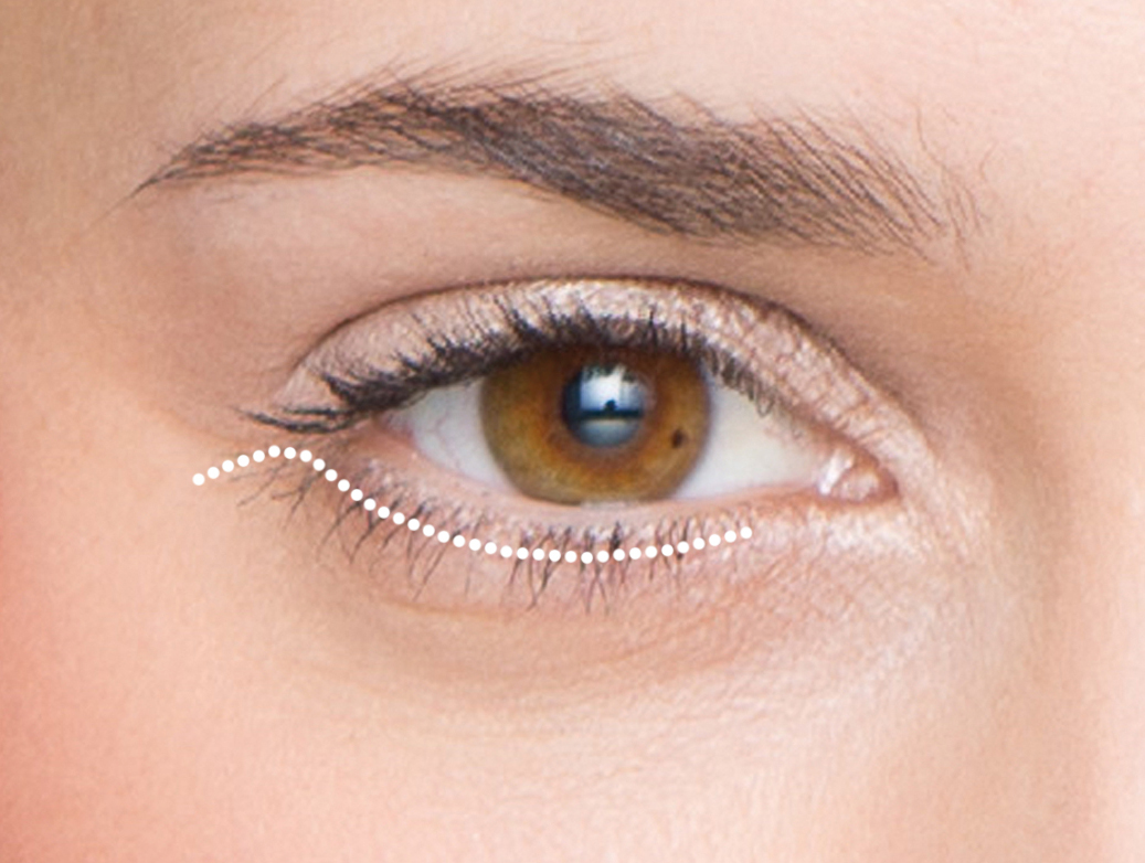 Unterlift von aussen: Über einen Schnitt in der zarten Falte unterhalb der Wimpern wird die überschüssige Haut entfernt.
